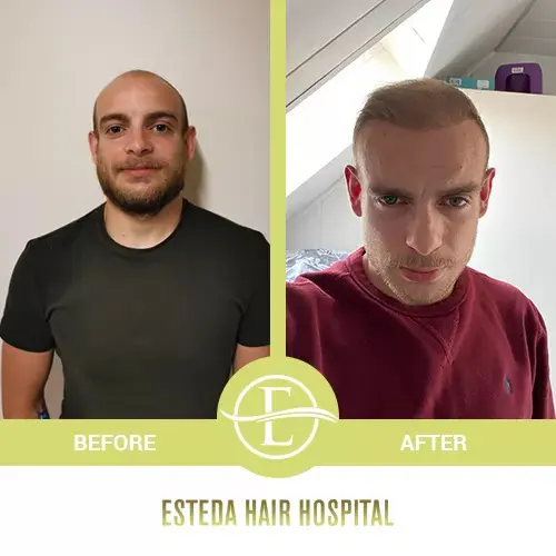 Hair Transplant Before-After