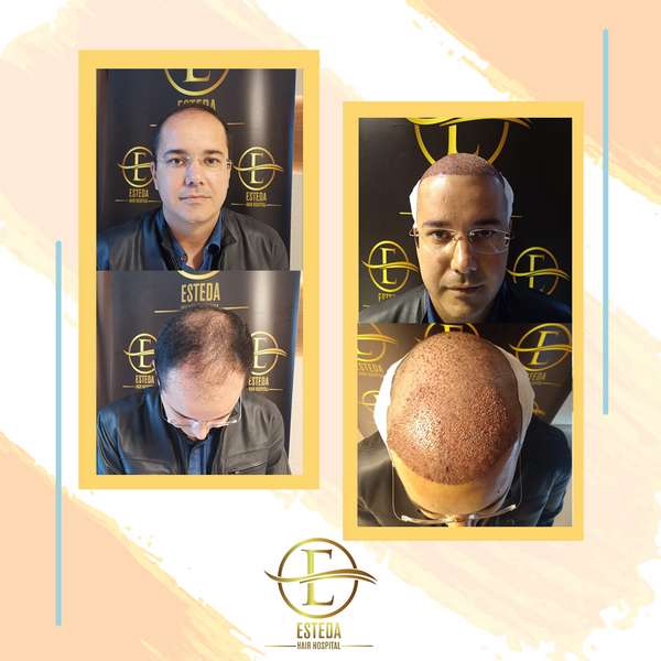Hair Transplant Before and After 14