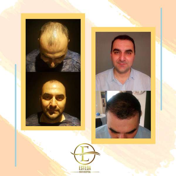 Hair Transplant Before and After 15