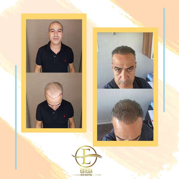Hair Transplant Before After 16