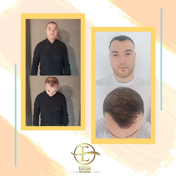 Hair Transplant Before and After 17
