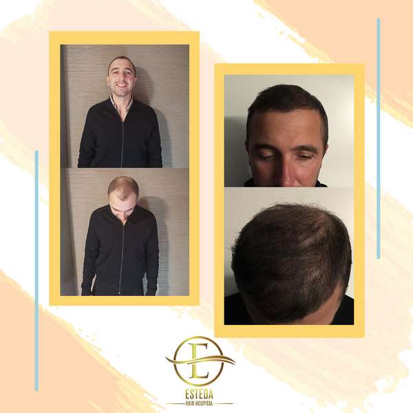 Hair Transplant Before and After 19
