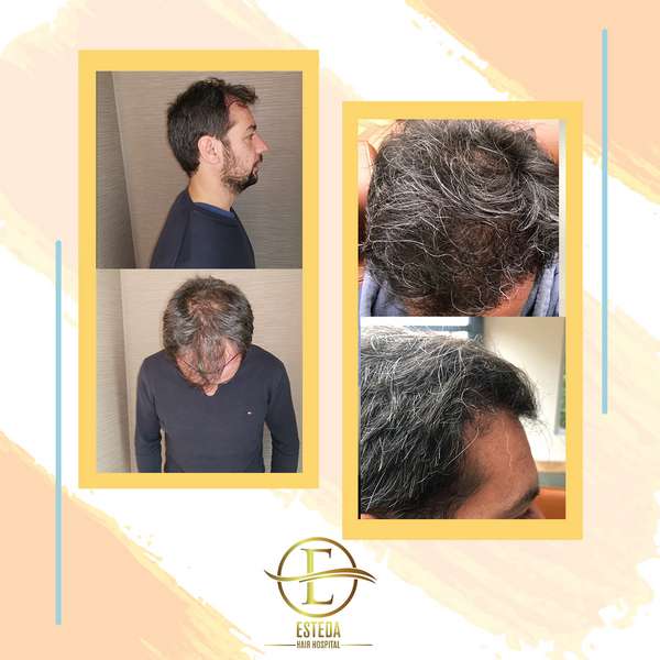 Hair Transplant Before and After 20