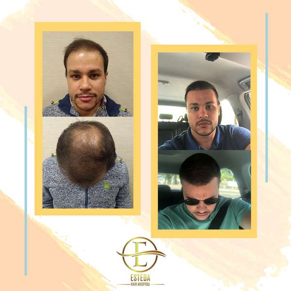 Hair Transplant Before and After 22