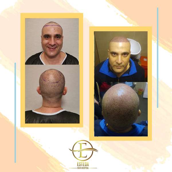 Hair Transplant Before and After 30
