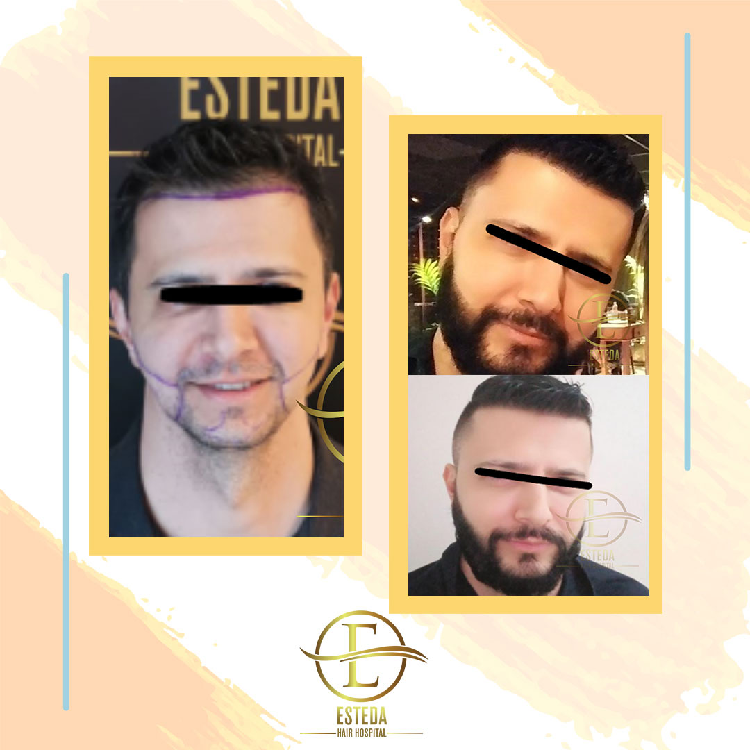 Hair Transplant Before and After 31