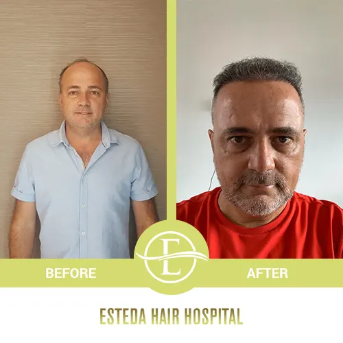 Hair Transplant Before-After