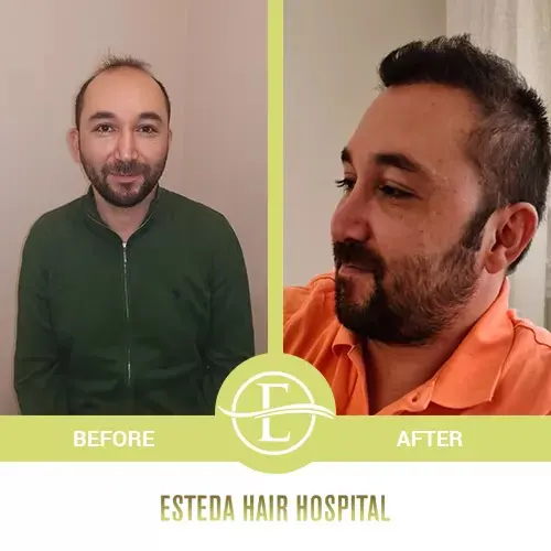 Hair Transplant Before-After