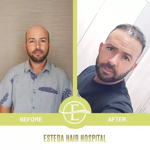 Hair Transplant Before-After