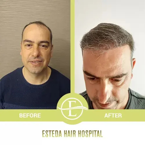 Hair Transplant Before-After