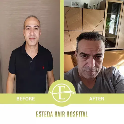 Hair Transplant Before-After