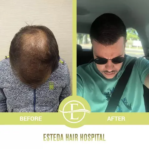 Hair Transplant Before-After