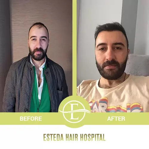 Hair Transplant Before-After