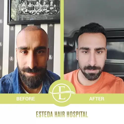 Hair Transplant Before-After