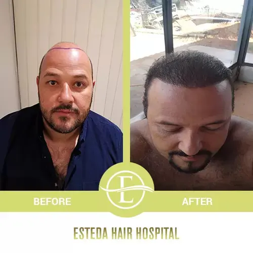 Hair Transplant Before-After