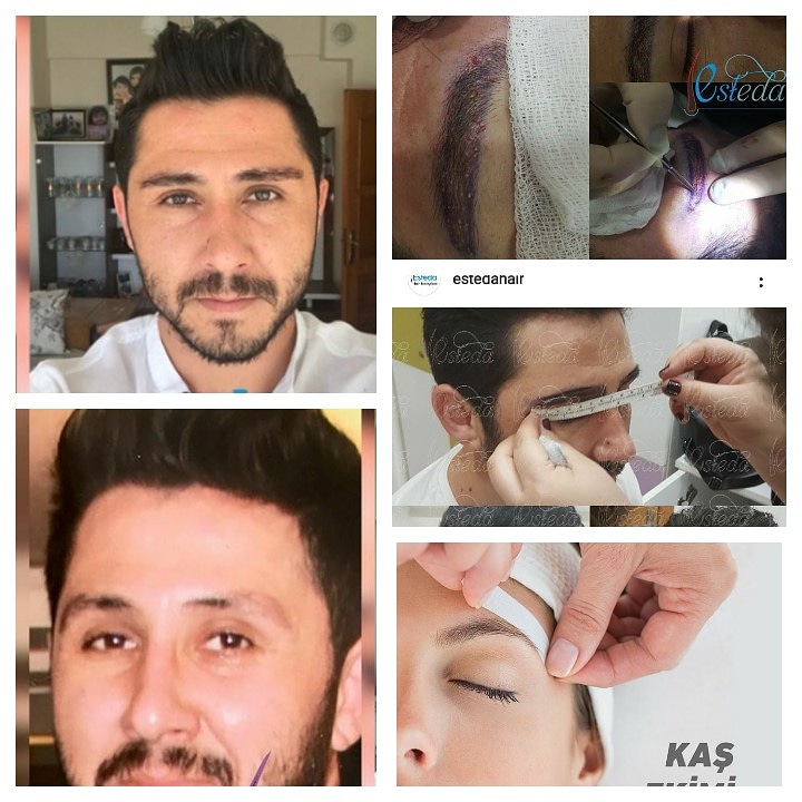 How is Eyebrow Transplantation Applied?