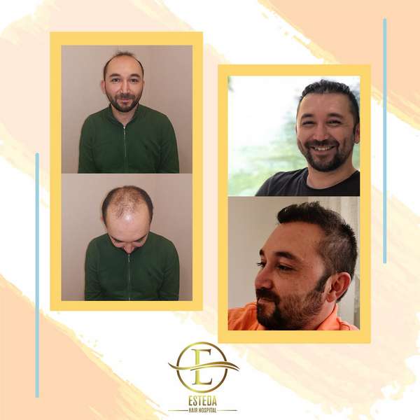 Hair Transplant Before After 1