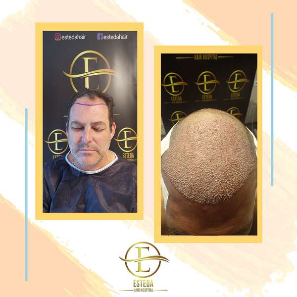 Hair Transplant Before After 12