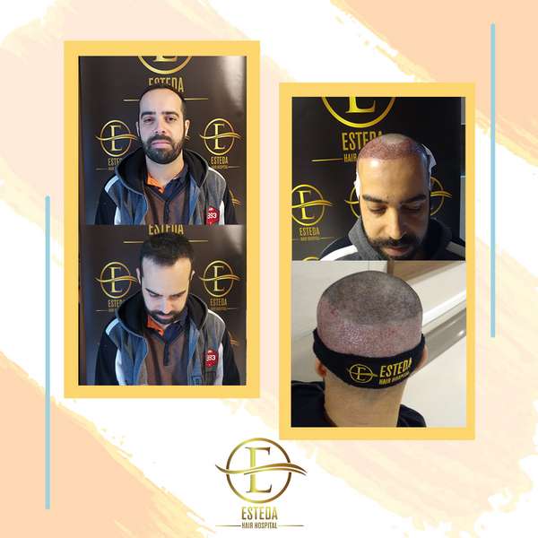 Hair Transplant Before After 13