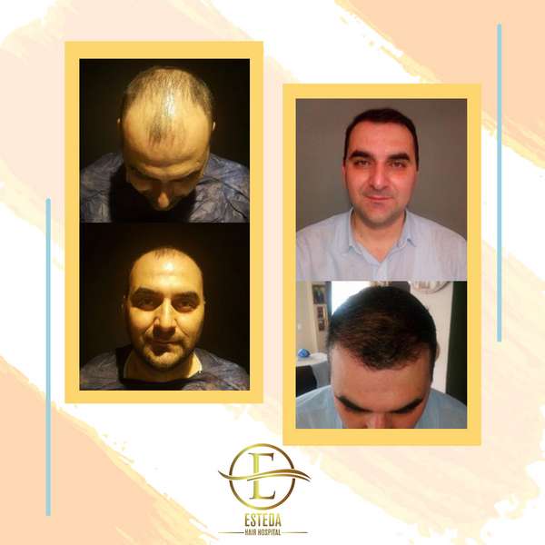 Hair Transplant Before After 15