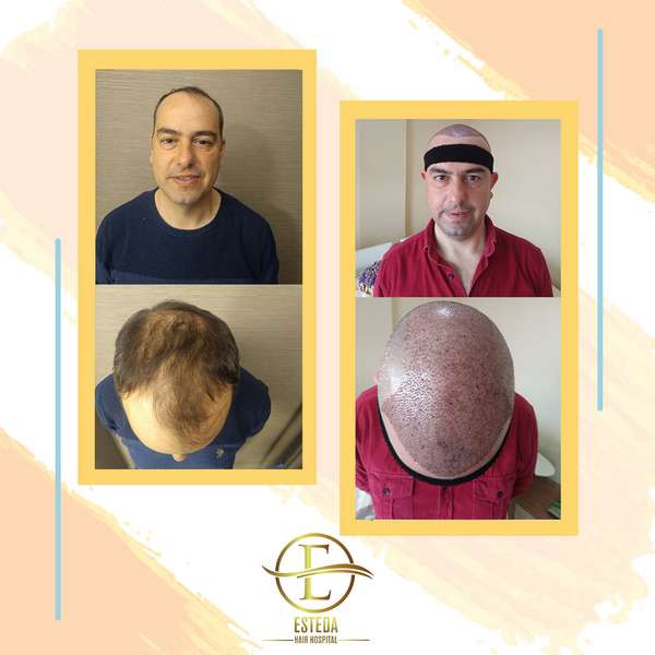 Hair Transplant Before After 2