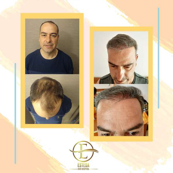 Hair Transplant Before and After 23