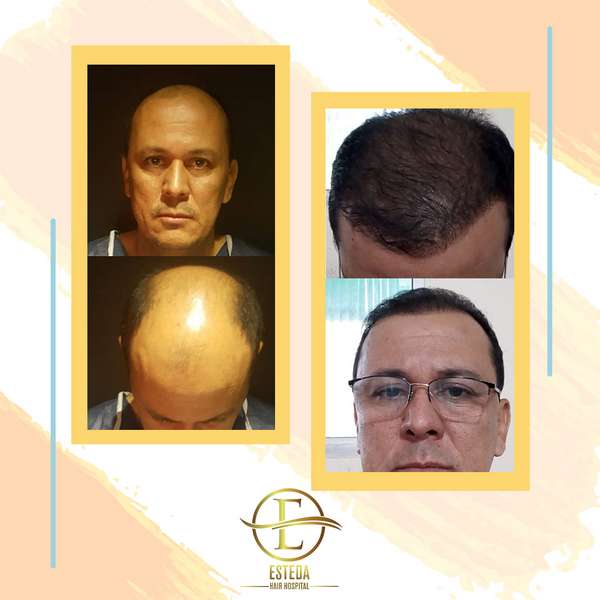 Hair Transplant Before and After 24