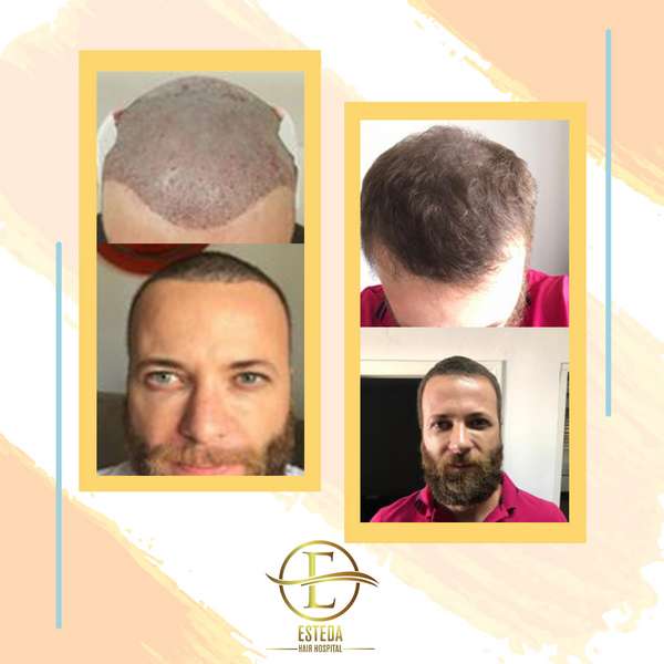 Hair Transplant Before and After 25