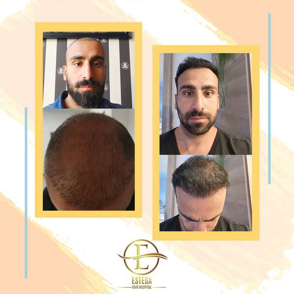Hair Transplant Before and After 26