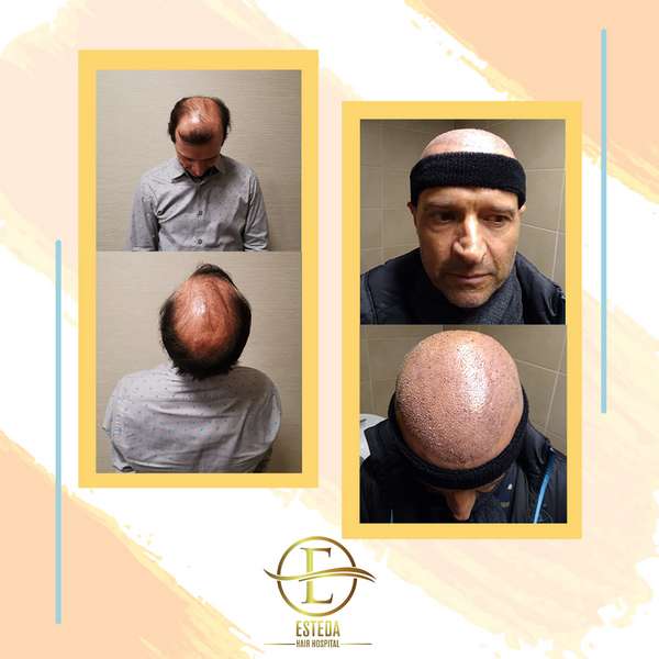 Hair Transplant Before After 3