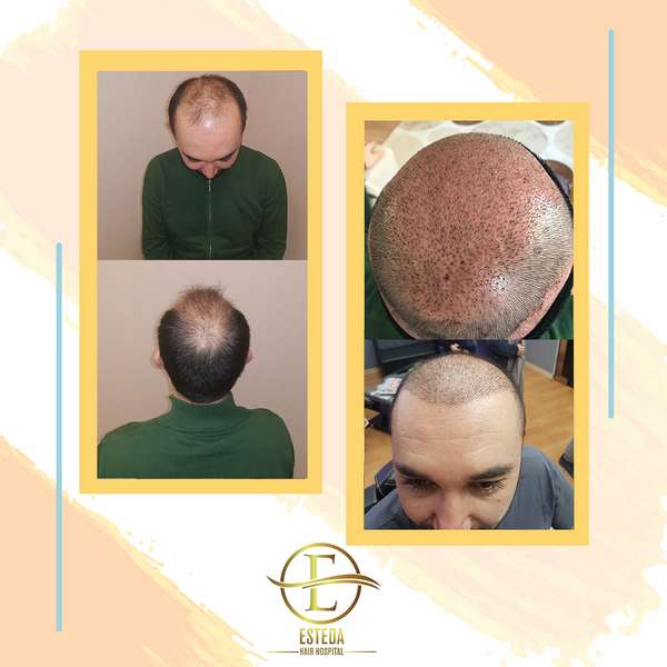 29+ Hair Transplant Sacramento Cost - SarfaraazOmar