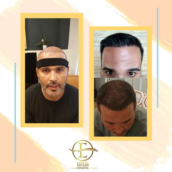 Hair Transplant Before After 6